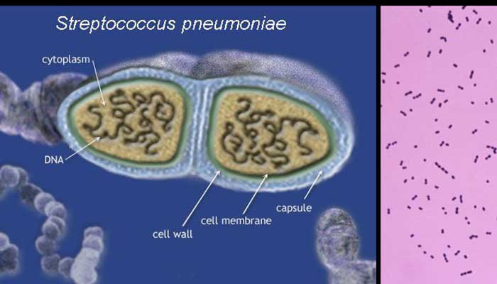 Phế cầu khuẩn - Streptococcus Pneumoniae là một trong những nguyên nhân có thể gây bệnh